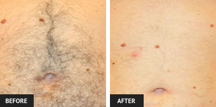laser hair removal pictures of St. Louis patient's stomach 