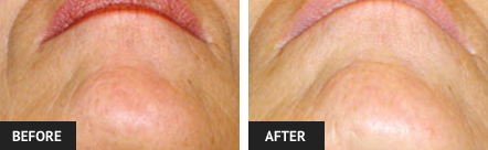 before and after laser hair removal pictures of woman's chin