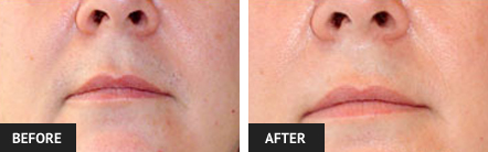before and after pictures of laser hair removal from upper lip