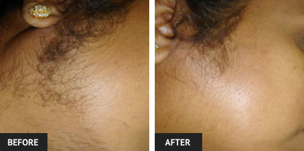 before and after laser hair removal of sideburns