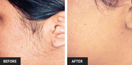 laser hair removal pictures of sideburns