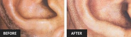 before and after laser hair removal pictures of an ear
