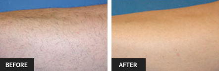 laser hair removal pictures of a St. Louis patient's arm