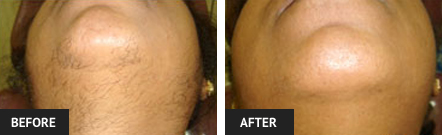 laser hair removal pictures of St. Louis woman's chin