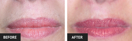 before and after laser hair removal pictures of woman's upper lip