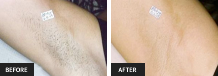 before and after laser hair removal pictures of armpit 