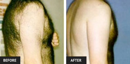 laser hair removal pictures of man's back