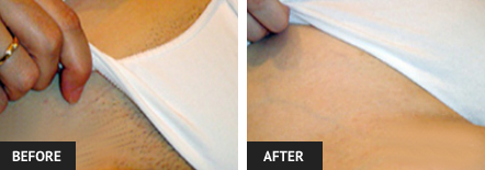 laser hair removal pictures of woman's bikini line
