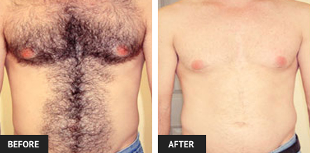 laser hair removal pictures of St. Louis man's chest