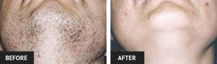 laser hair removal pictures of St. Louis man's chin