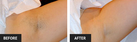 laser hair removal pictures of armpit