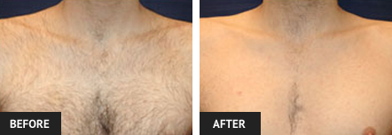 laser hair removal pictures of man's chest in St. Louis