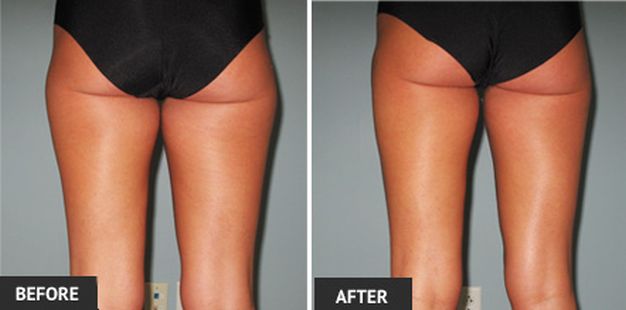 Before and after outer thigh liposuction. 