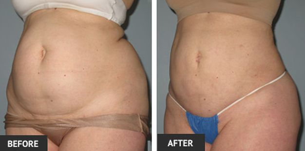 before and after photos liposuction