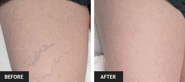 Before and After vein doctor st louis
 treatment