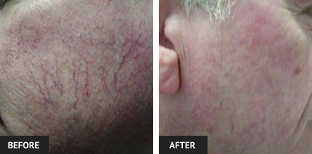 Facial spider veins on cheek mostly gone after one VeinWave vein treatment. Before and after picture.