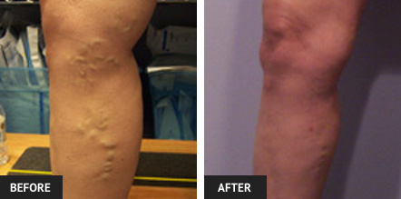 Before and after pictures of leg after Endovenous Laser Ablation and sclerotherapy to remove varicose veins.