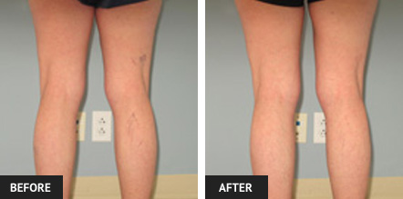 Before and after photo of leg after cosmetic sclerotherapy treatment to remove unsightly spider veins.