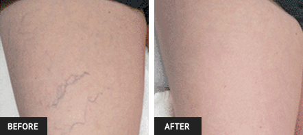 Vein treatment before and after picture of leg after cosmetic sclerotherapy treatment to eliminate blue veins