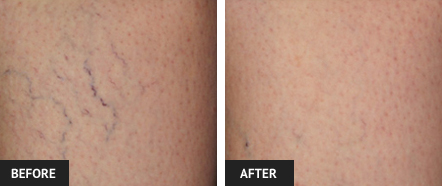 Before and after spider vein treatment by St. Louis vein expert Dr. Wright.