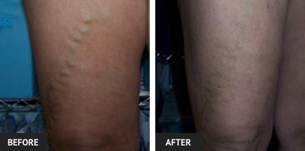 Vein treatment before and after photo of thigh after EVLT for ropey varicose vein