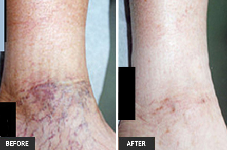 Sclerotherapy vein treatment before and after photo of ankle veins.