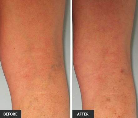 Blue veins behind the knee easily treated with sclerotherapy in our St. Louis vein center.