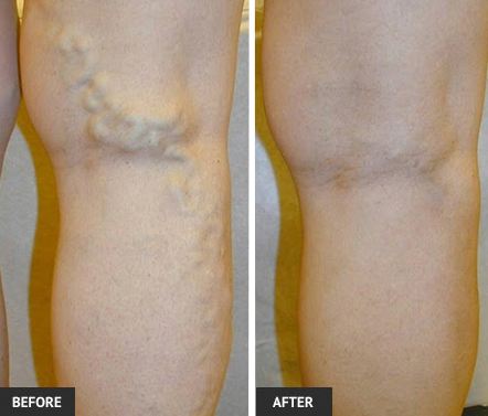 Thick, ropey varicose veins respond well to Radiofrequency Ablation (RFA) vein treatment. Before and after photo shows vein treatment before and after. 