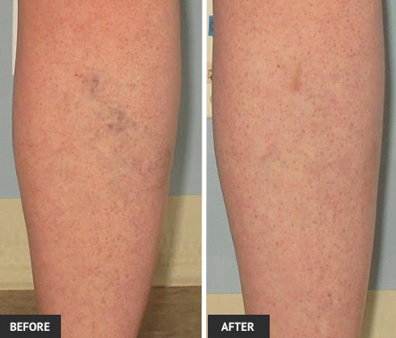 Annoying spider veins respond to sclerotherapy vein treatments in our St. Louis vein center.