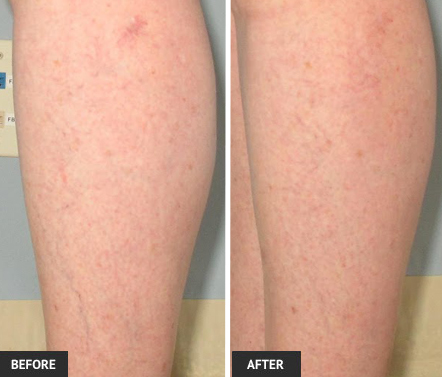 Legs are improved after vein treatment. Before and after photos above.
