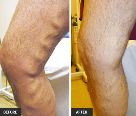Before and after photos of large varicosity after ablation vein treatment before and after