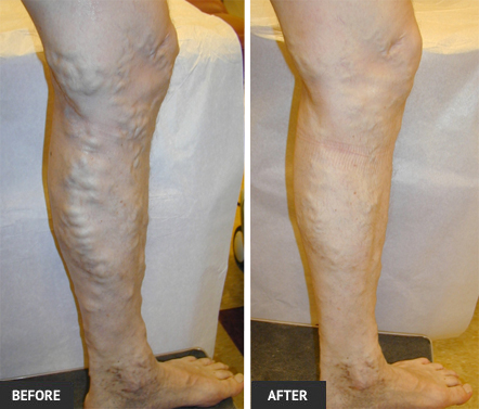 Very painful veins are easily treated with symptoms subsiding quickly. vein treatment before and after 