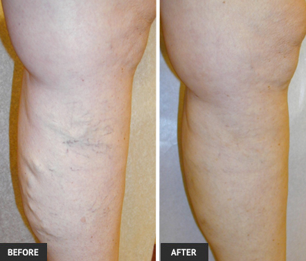 Blue veins are not just a cosmetic issue. Vein removal before and after photos.