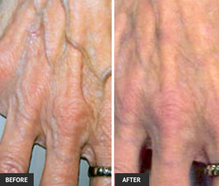 Hand veins can easily be removed. Vein removal before and after pictures.