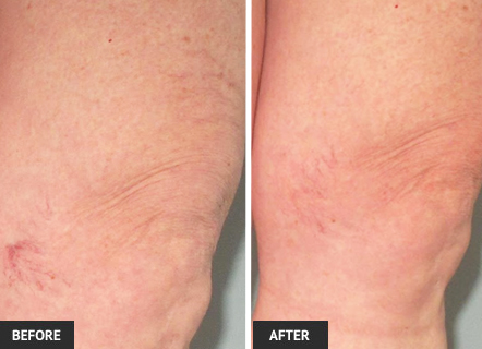 Matted veins respond very well to treatment in our St. Louis vein center.