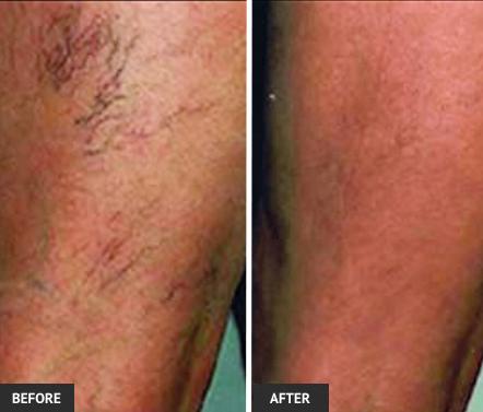 Vein removal before and after photo of veins treated with sclerotherapy in our St. Louis vein center.
