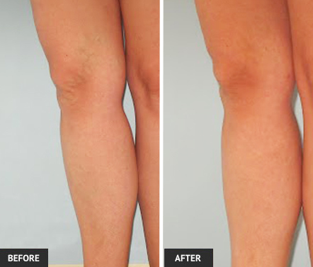 A ropey blue vein above the knee responded beautifully to vein treatment. Before and after pictures above.