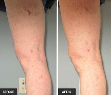 Living with unsightly veins is not necessary; Vein treatment is easy and quick.
