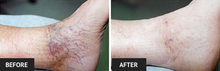 Before and after the vein disease treatment alternative sclerotherapy.