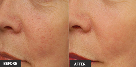 Before and after cosmetic vein treatment
