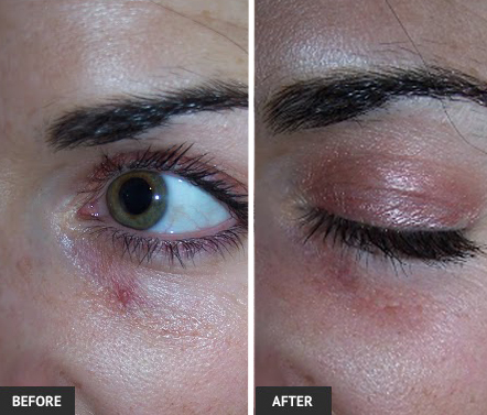 Eye veins detract from a great appearance; vein treatment is easy. vein treatment before and after