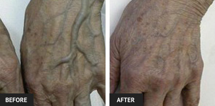 Hands after several sclerotherapy treatments for vein removal treatment. Before and after photo.