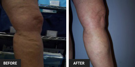 Leg after several sclerotherapy vein treatments to remove varicose veins.