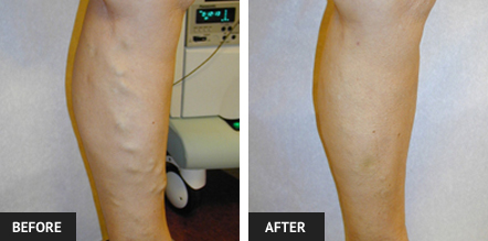 Leg after Radio Frequency Ablation (RFA) and sclerotherapy to remove varicose veins.