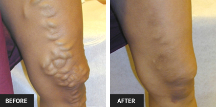Before and after picture of varicose vein care in St. Louis