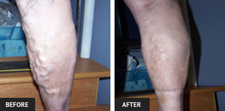 Vein removal before and after photos of leg after Endovenous Laser Treatment (EVLT) and sclerotherapy to remove large varicose veins.