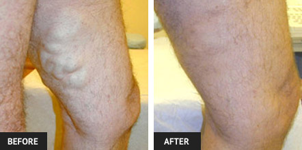 Before and after pictures of leg after Endovenous Laser Treatment (EVLT) to remove large varicose veins