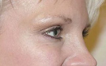 Botox-skin treatment-results
