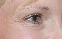 Botox-skin-treatment