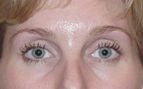 botox-eye treatment-eyes